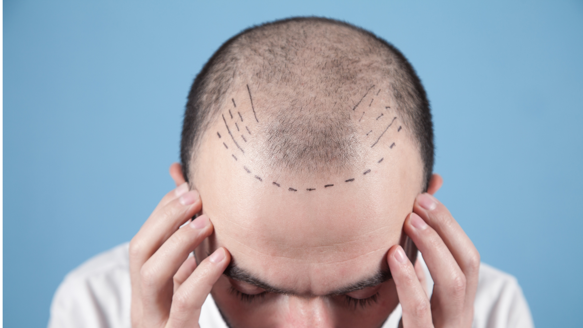 Hair Transplant Image