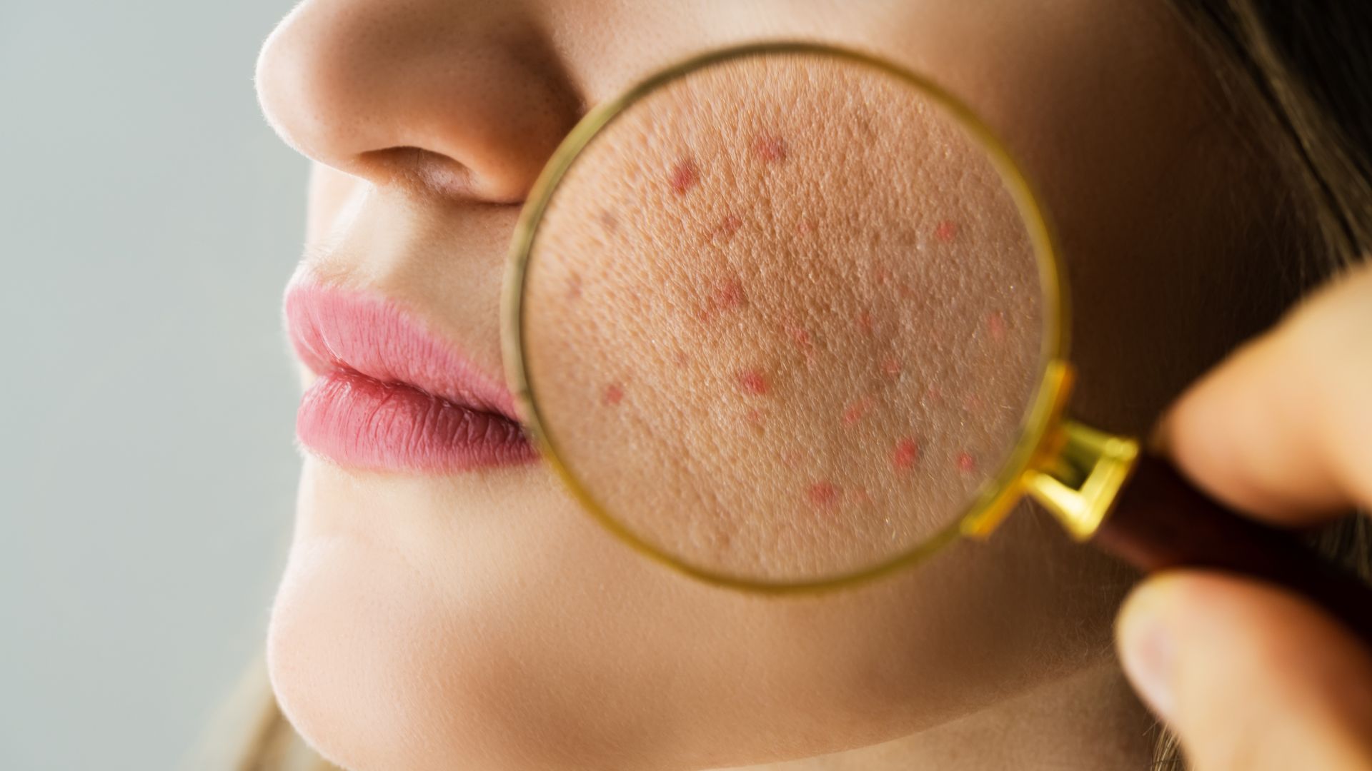 Understanding Acne: Causes, Treatment, and Prevention