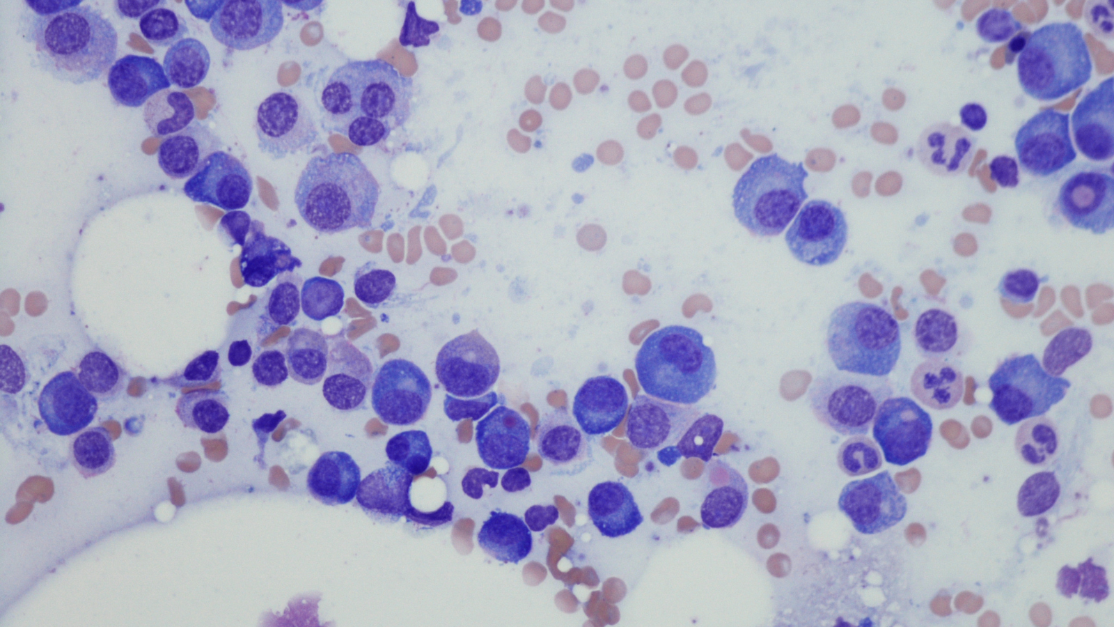 Bone marrow aspiration Image